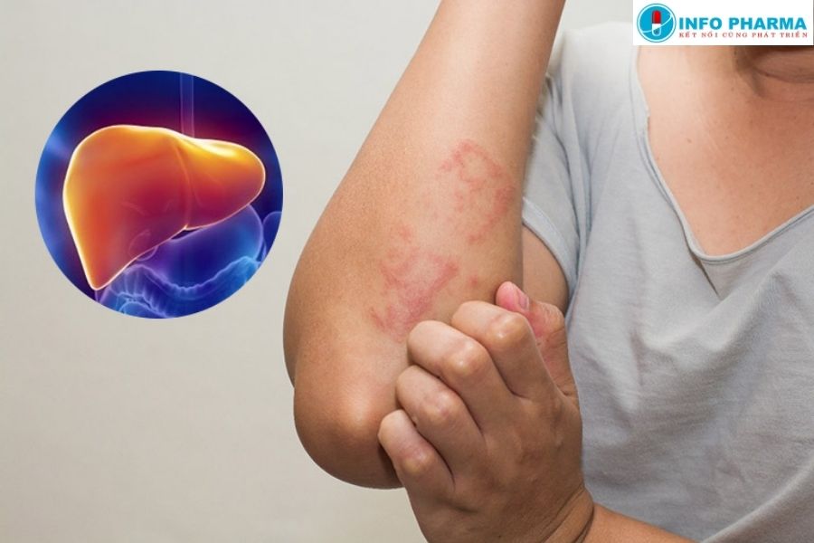 Người có biểu hiện nóng gan